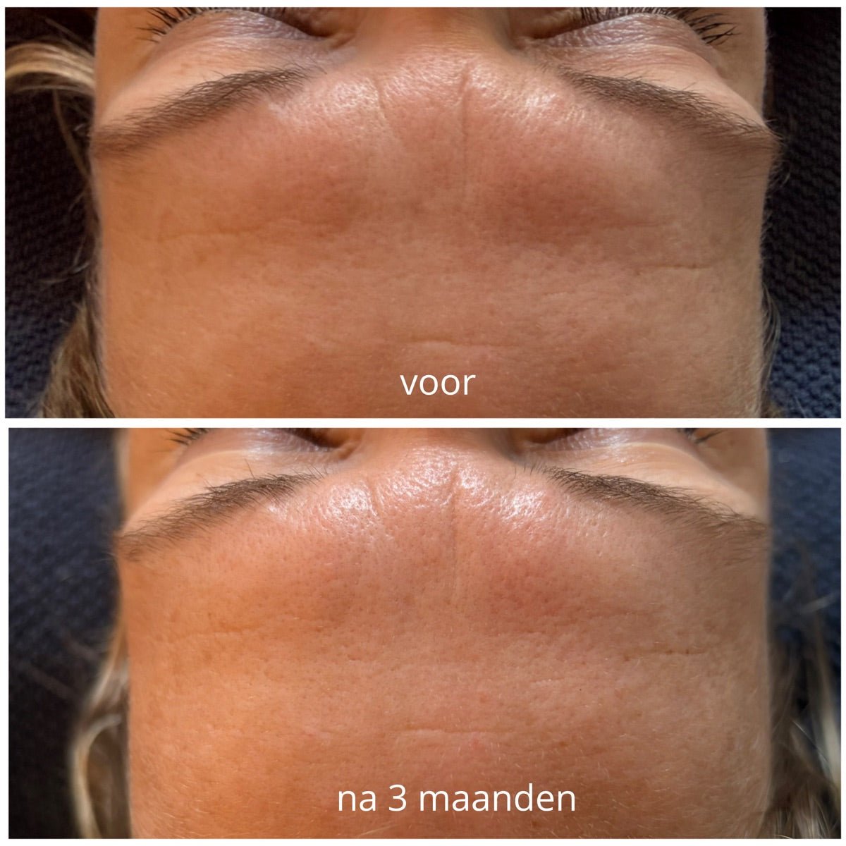 Voorhoofd na de PrisiFique-routine (na 3 maanden)