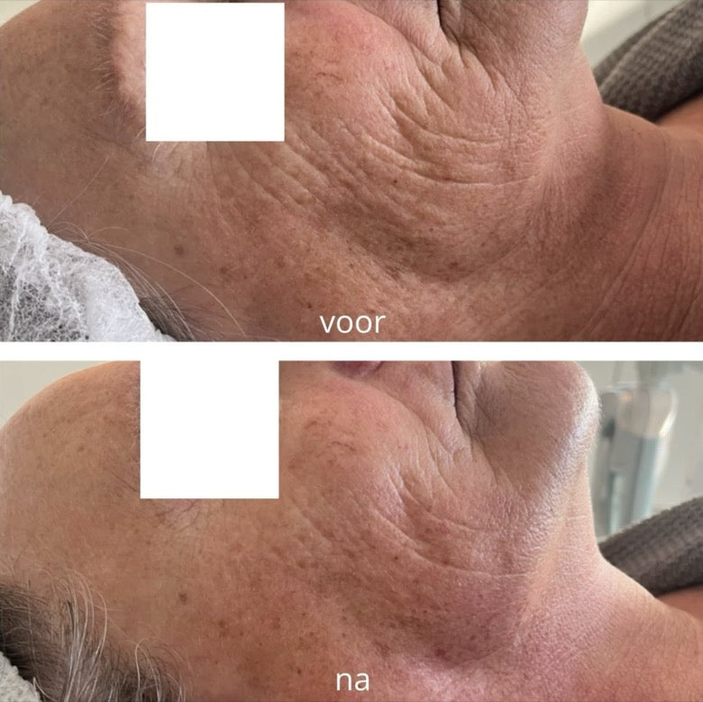 Twee foto's van de wang en de hals van dezelfde klant, in dezelfde hoek