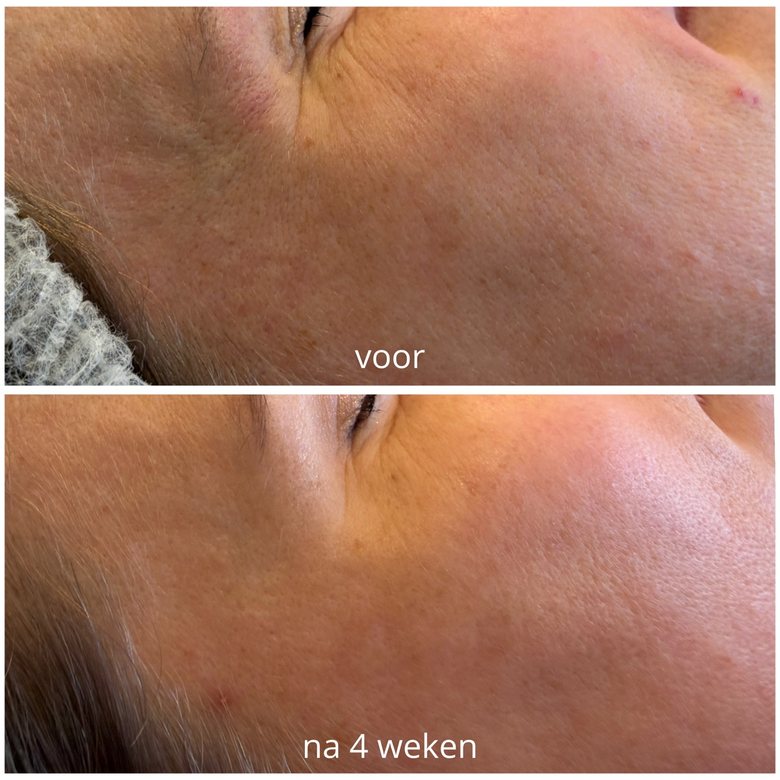 Voor en na 4 weken: twee foto's van de wang en de slaap van een tweede klant, in dezelfde hoek