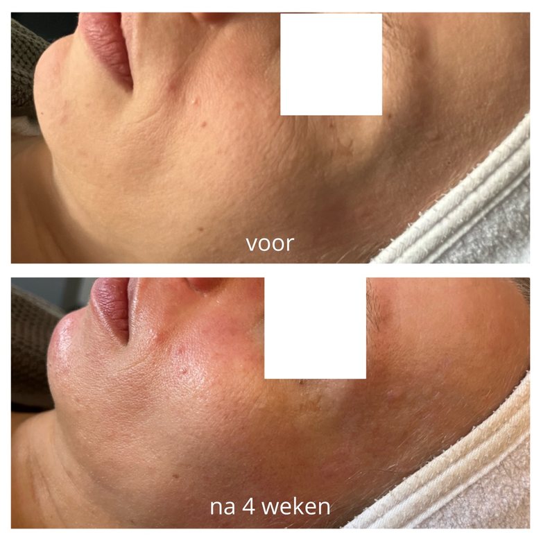 Voor en na 4 weken: twee foto's van de kin en de kaaklijn van een derde klant, in dezelfde hoek