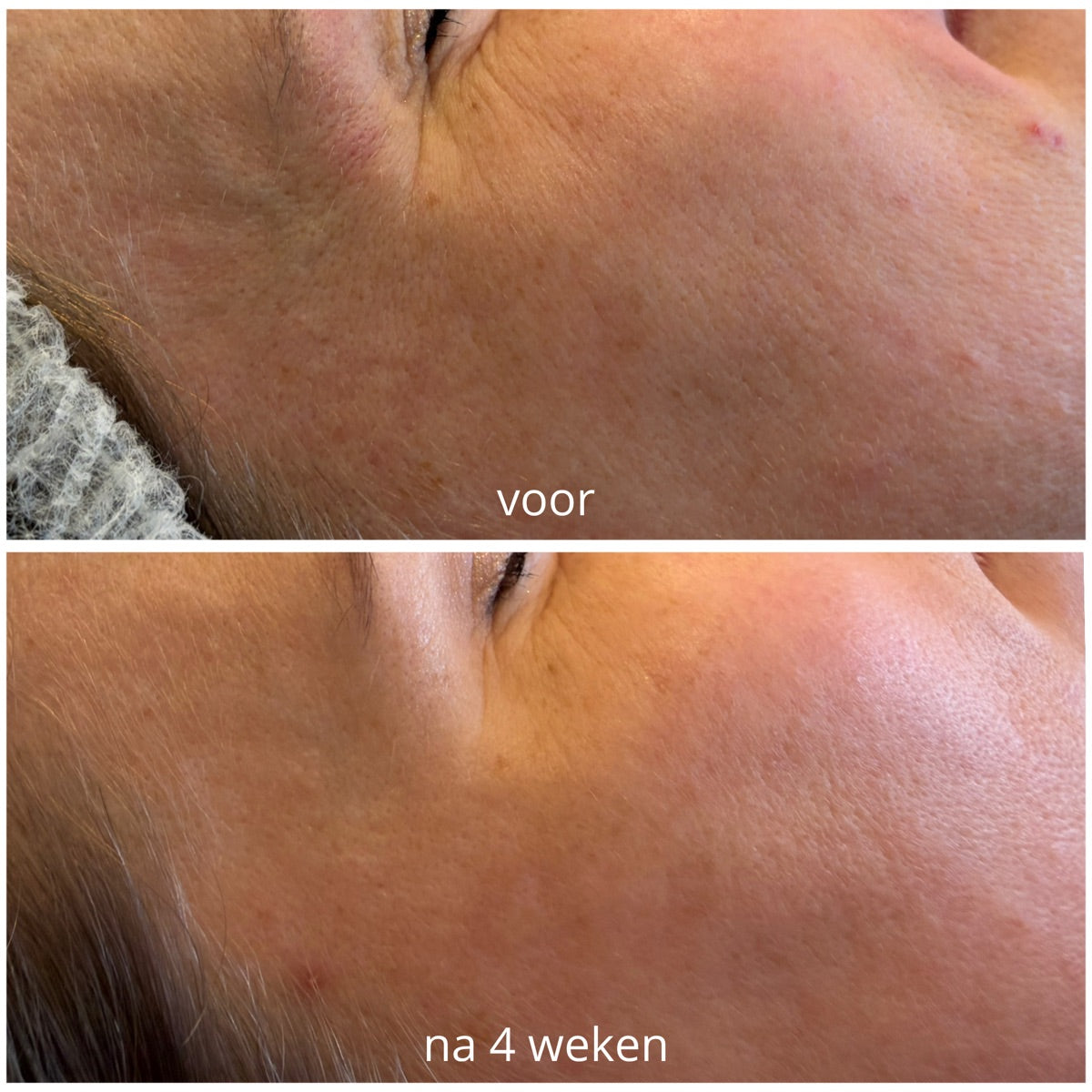 Wang en slaap na de PrisiFique-routine (na 4 weken)