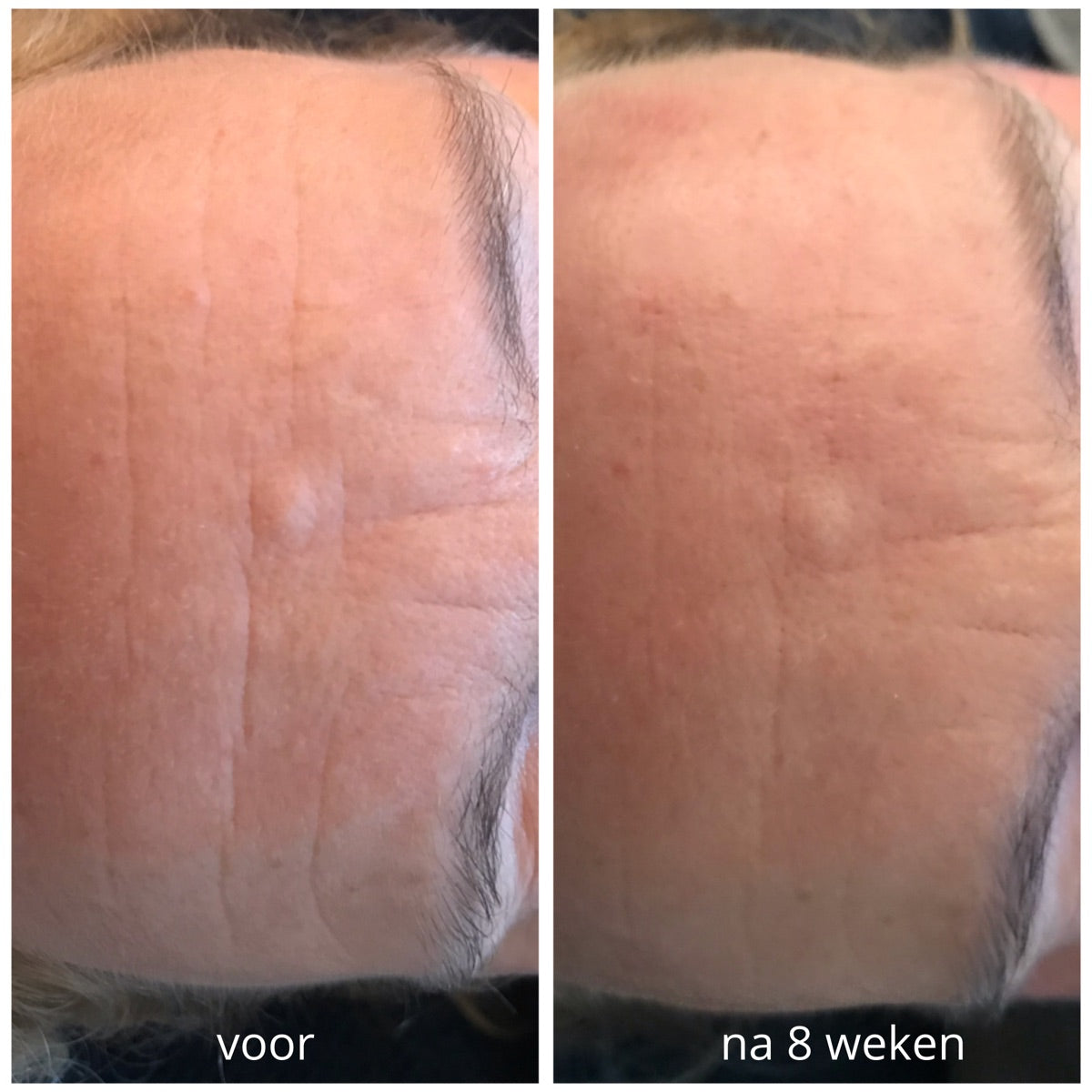 Voorhoofd na de PrisiFique-routine (na 8 weken)