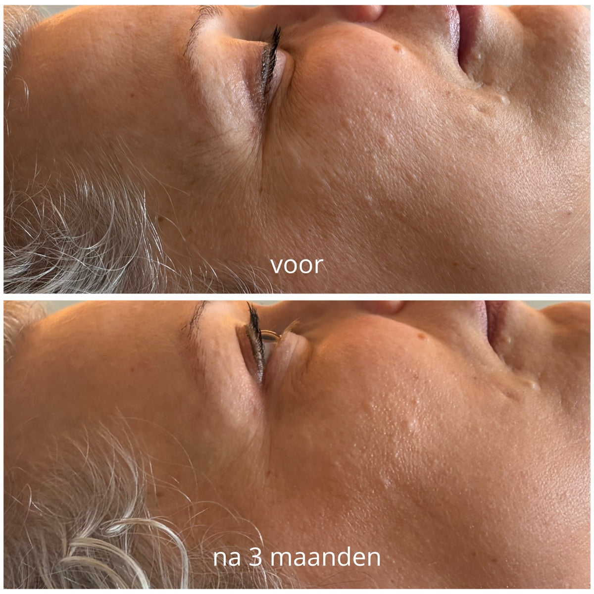 Ooghoek en wang na de PrisiFique-routine (na 3 maanden)