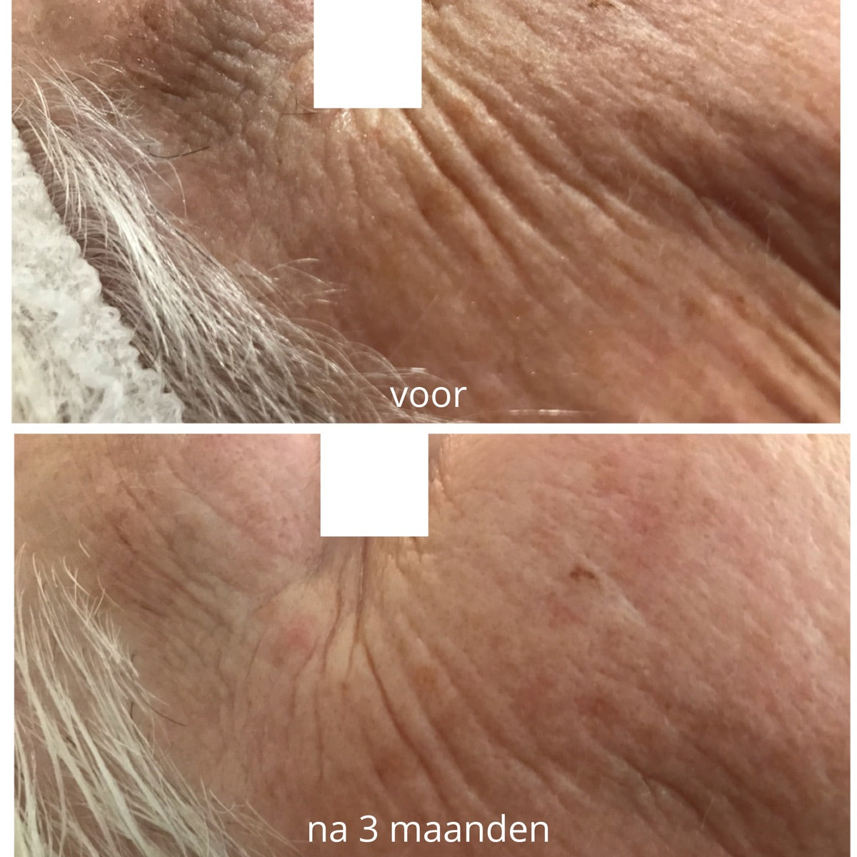Ooghoek en slaap na de PrisiFique-routine (na 3 maanden)