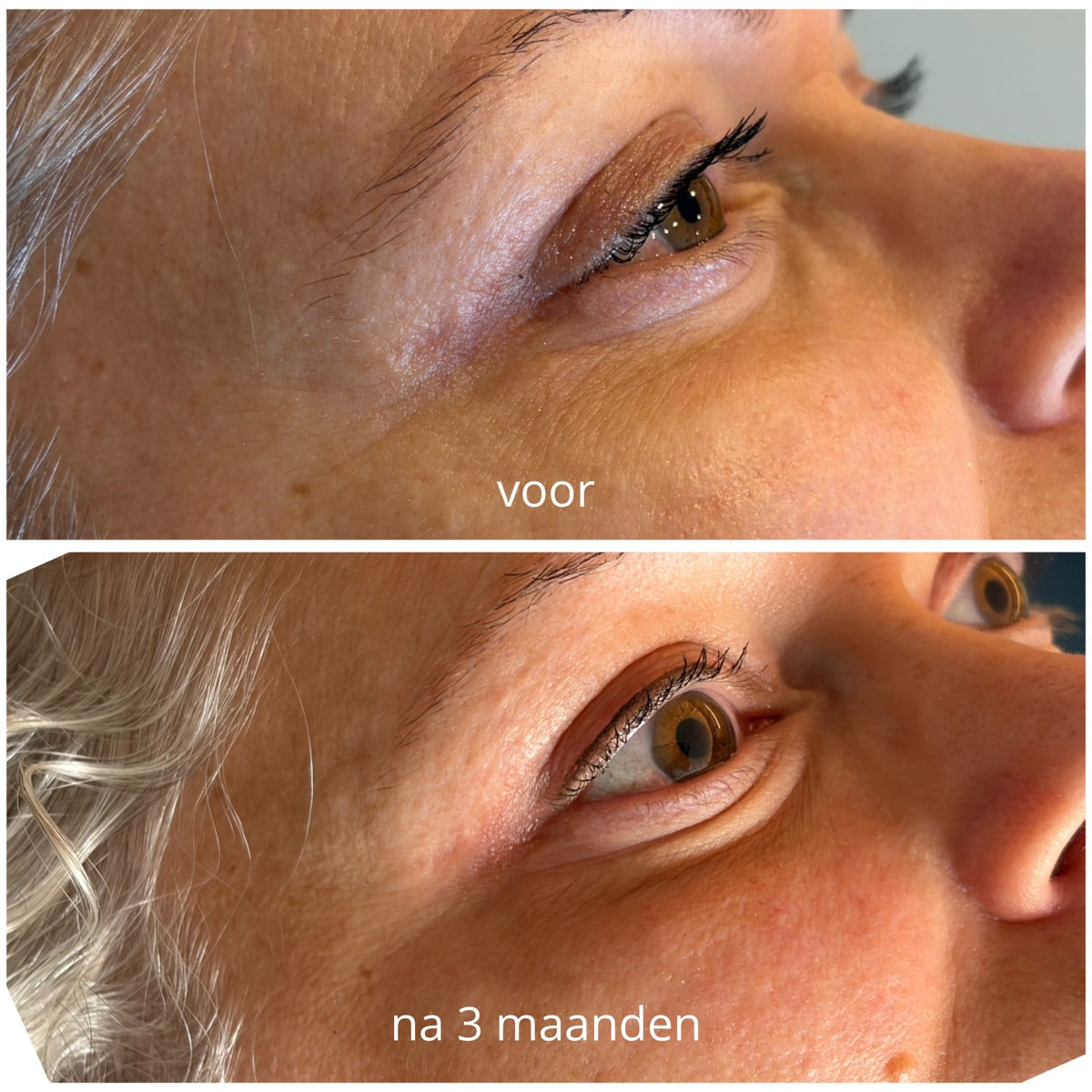 Rond het oog na de PrisiFique-routine (na 3 maanden)
