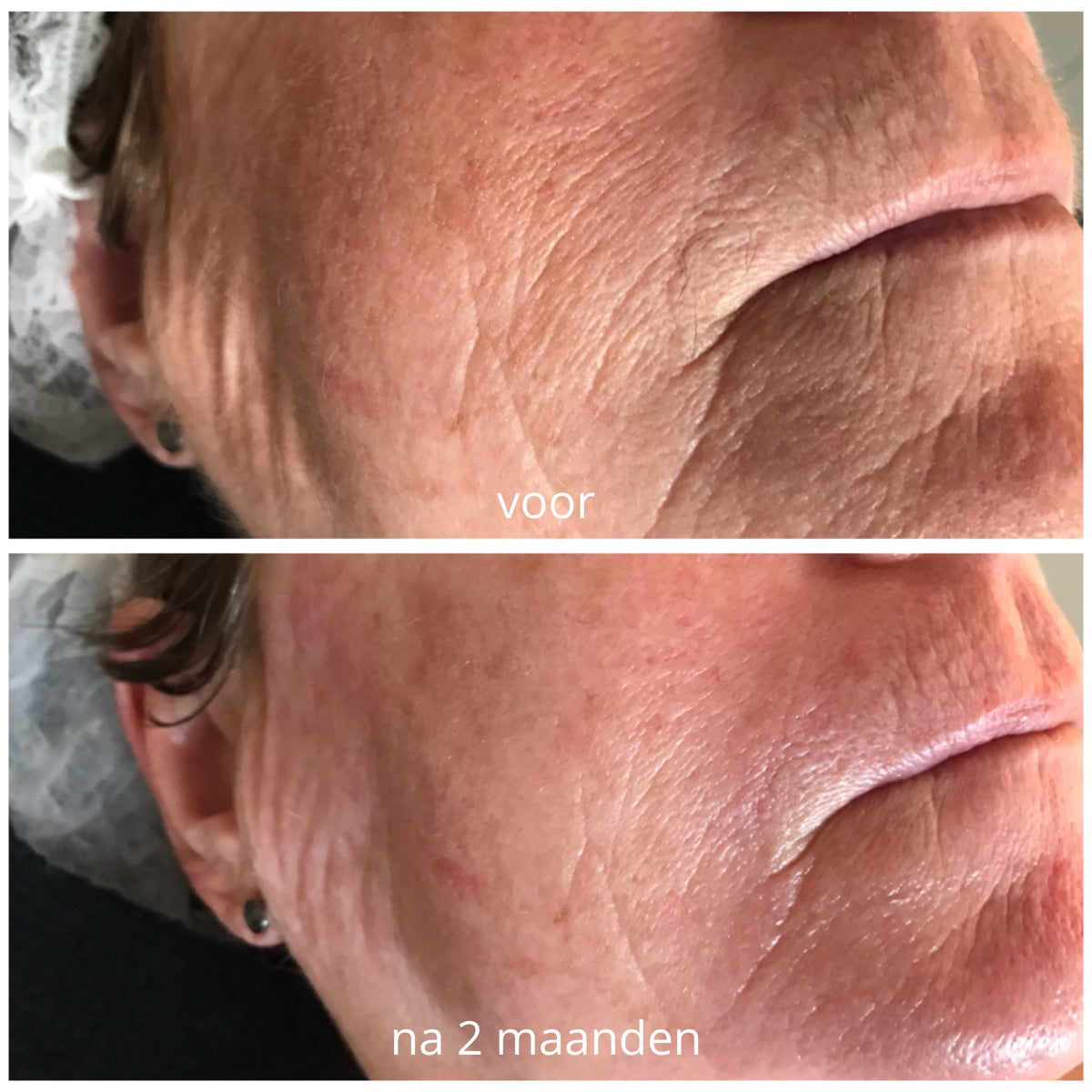 Kaaklijn na de PrisiFique-routine (na 2 maanden)