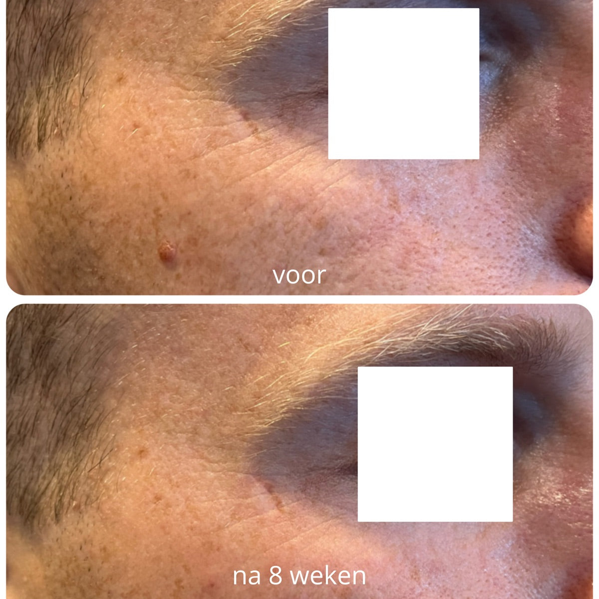Rond het oog na de PrisiFique-routine (na 8 weken)