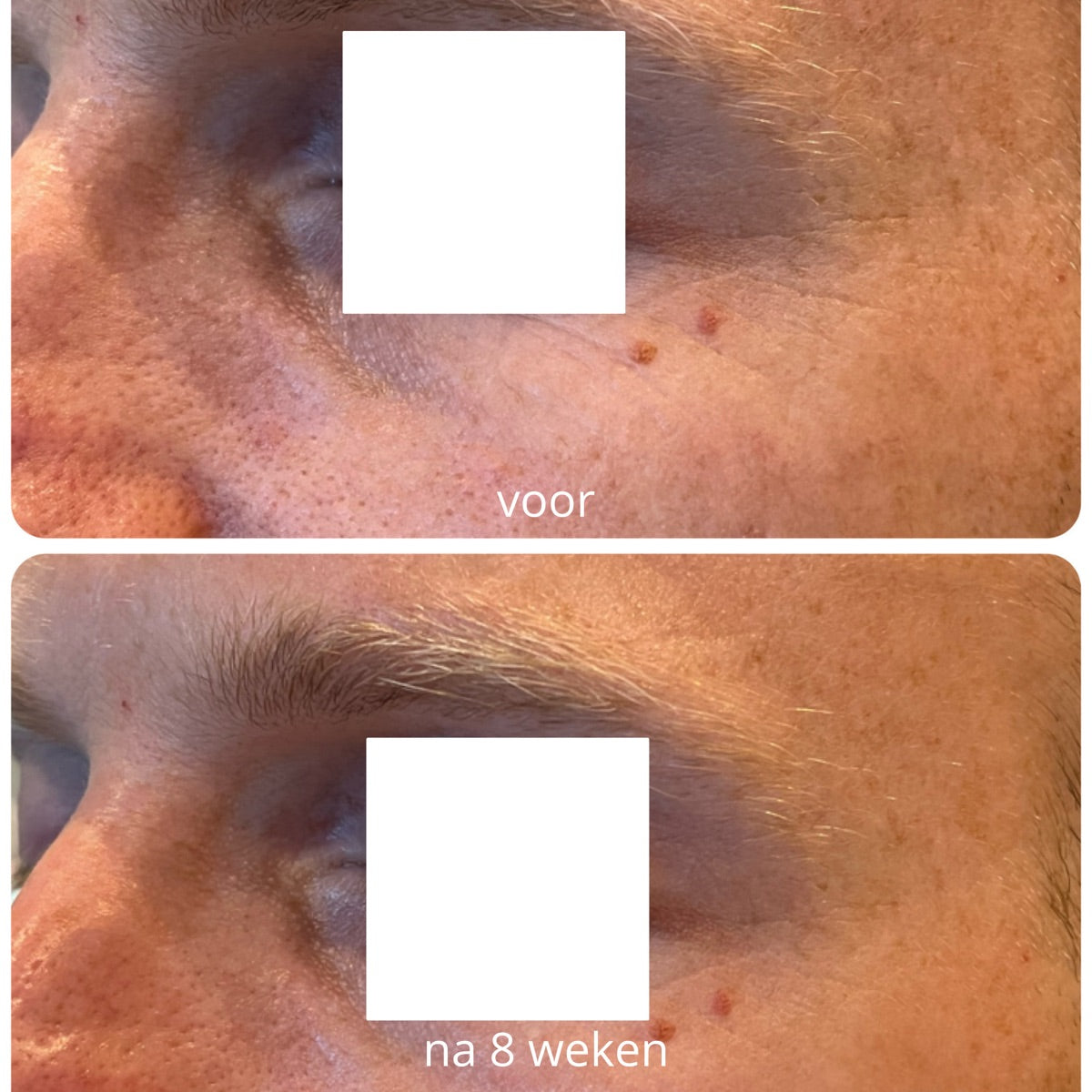 Rond het oog na de PrisiFique-routine (na 8 weken)